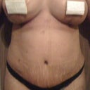 10 days post op.