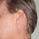 6 months after treatments (5).  I've managed to keep the benefits by using sunscreen every day.
