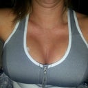 Day 5 Post op. 457 cc Allegan gel implants under the muscle.