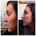 Profile before, 1 week after cast removal
