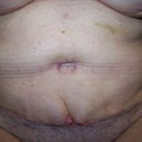 almost 2 weeks don't think I should be having skin rolls does anyone know about this? DR says it looks great??