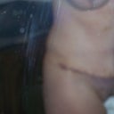 2 Week the lipo isn't even notice the indention in my side hoping it will even out 