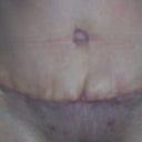 2 Week scare notice the center of the incision 