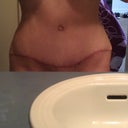 TT scar at 13 weeks PO