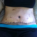 1 wk PO scar...