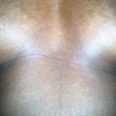 Pre-surgery