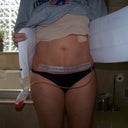 4 days post op mini tummy tuck