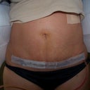 4 days post op mini tummy tuck
