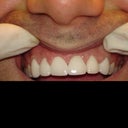 Change Composite To Porcelain Veneers