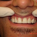 Change Composite To Porcelain Veneers