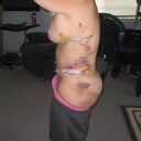 1 week post op