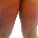 Week two bruising and swelling almost gone!