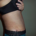 Look how far back I am leaning! Just the opposite of what I could do the first week! 1 month post op.