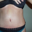 In this picture you can see the teeny tiny red mole that was way above my old belly button (which was higher before surgery and I am glad he moved it down a little, it looks more proportioned. Look where the red mole is now!