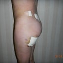 3 days after fat transfer by Dr. Coleman