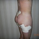right side 3 days after fat transfer by Dr. Coleman
