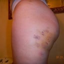 View of left side 6 days after transfer.