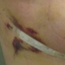 1 week post-op (left)
