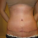 4 weeks- incision