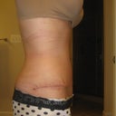 4 weeks- side incision
