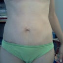 3 months post-op