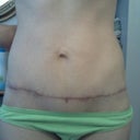 3 months post-op scar