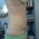 3 months No more tummy skin bulge!