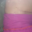 2011 - 6 & 1/2 weeks - scar starting to lighten.