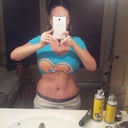 6 weeks post op. Still swelling on hips where lipo was done