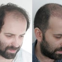just before the surgery and on the 4th day after the surgery before I leave Istanbul