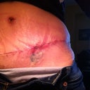 6WPO spitting stiches