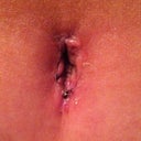 BB 2 weeks post op