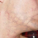 checkerboard pattern only gets worse with more treatment