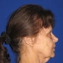 Before Side View