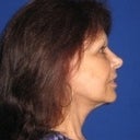 After Side view