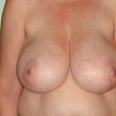 The day before surgery