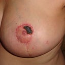 1 month after surgery...38D
