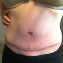 Week 5 - I find my PS has the most beautiful scars. And I scar terribly! Couldn't be happier.