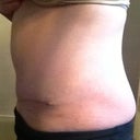 Week 5 - notice shadowing of my indent/crease on my hip. Hope it resolves.