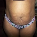 before surgury pics