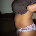 side view before surgury
