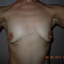 chest before nipple reduction and augment