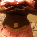 4 days post op front view