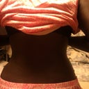 4 days post op back view