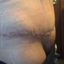 Jagged scar on one side. 17 day po