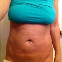 3rd day. I see a difference!! bruises are starting to show.