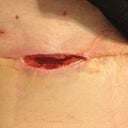 This is the wound that had to be left open. Approx 2 1/2" long and 2" deep.