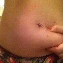 Before procedure front view - pinching fat
