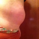 After procedure, day 1, side view. Looking pregnant in clothes.