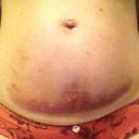 After procedure, day 2, front view bruising.